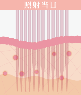 照射当日