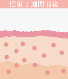 照射1週間前後