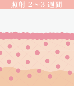 照射2~3週間